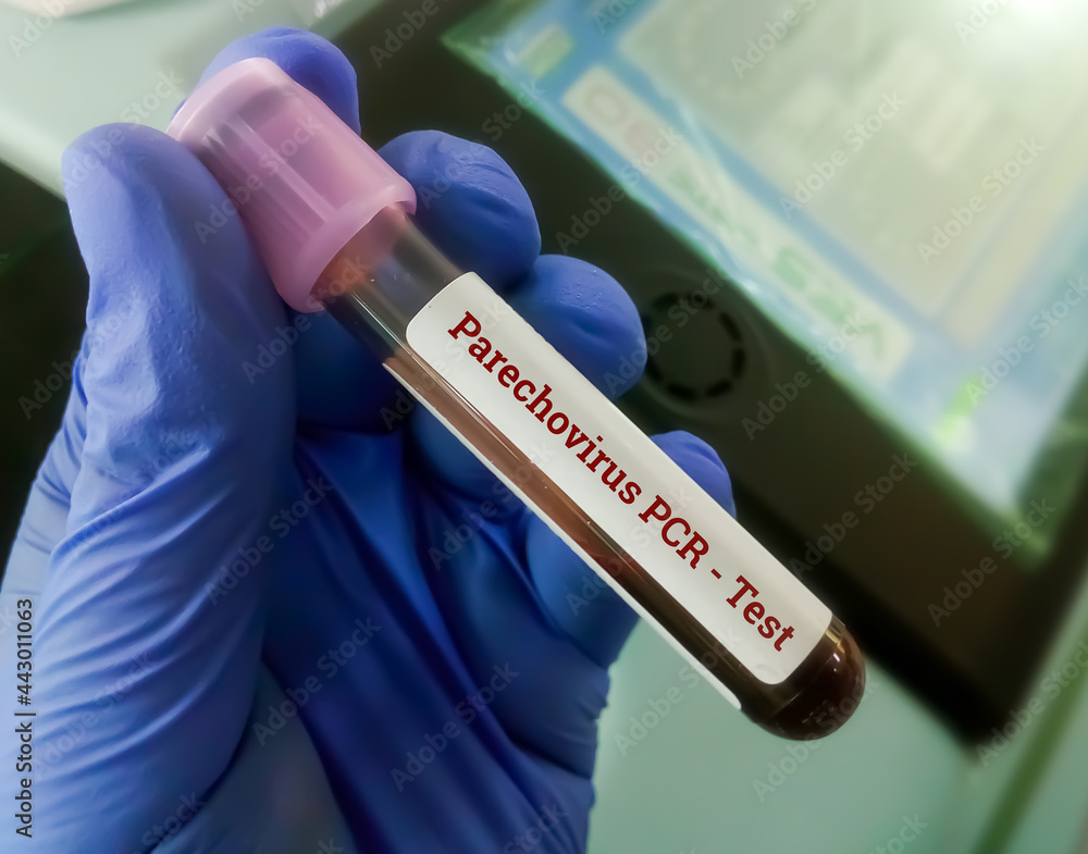 Fototapeta premium Blood sample for Parechovirus PCR test