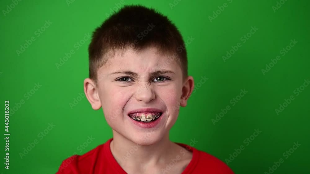 The boy is smiling, aligning his teeth with a dental plate, dental care. The boy is smiling, aligning his teeth with a dental plate, dental care.