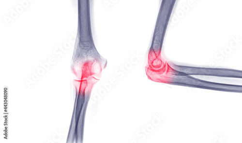 X-ray Elbow or Radiography of Right elbow AP and Lateral view for diagnostic fracture of elbow. photo