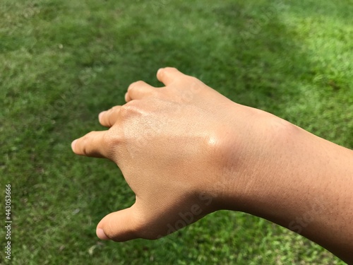 Valokuva Ganglion cyst on right wrist, open hand