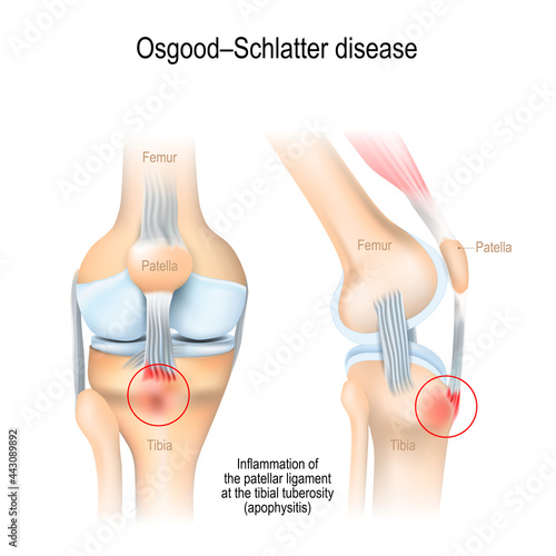 Osgood–Schlatter disease. inflammation of the patellar ligament in knee photo