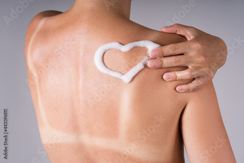 Sunburned woman, sunburn marks on the body, heart-shaped sunscreen on the back