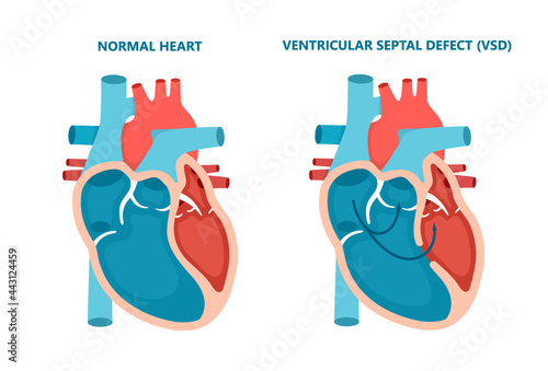 Ventricular septal defect VSD. Human heart muscle diseases cross-section. Cardiology concept.