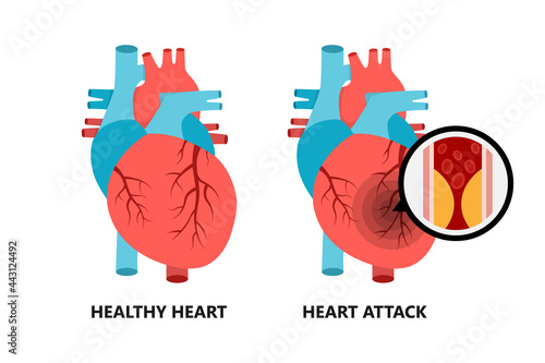 Healthy and unhealthy heart. Heart with atherosclerotic plaque.