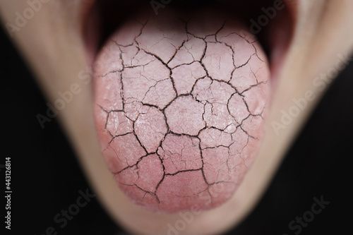 Fototapeta Woman Unhealthy Cracked Dry Tongue