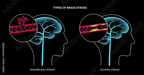 Brain stroke ishemic and hemorrhagic