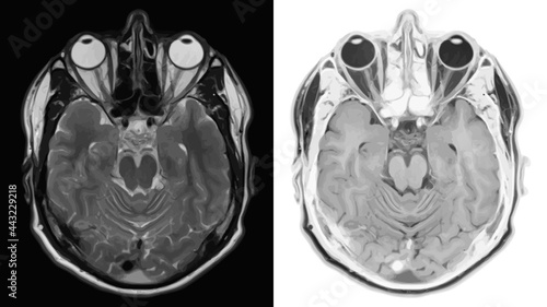 Realistic cross section of brain with CT scan, MRI Magnetic resonance imaging of head layer. Vector illustration.