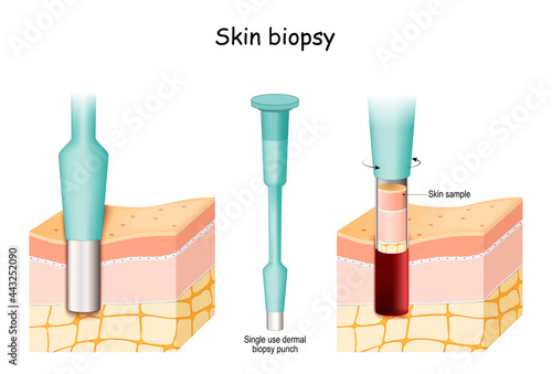 Skin Biopsy. Punch biopsy take skin sample.