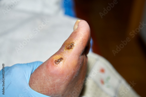 Foto cutaneous ulcer on the first toe in an elderly diabetic person
