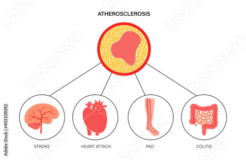 Types of ishemia