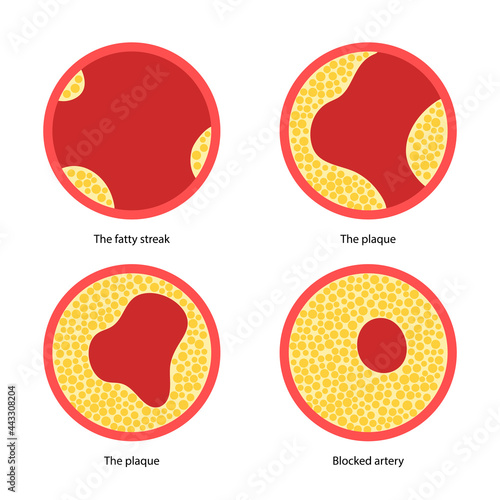 Cholesterol and atherosclerosis
