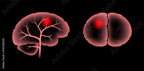 Brain pain disease