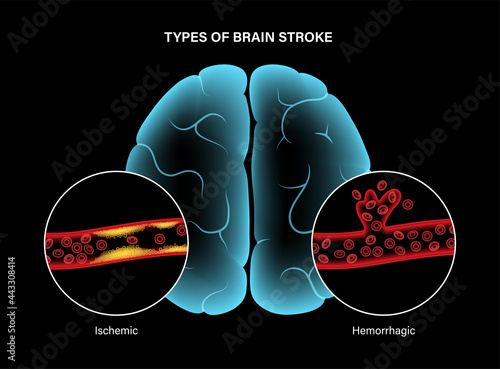 Brain stroke ishemic and hemorrhagic