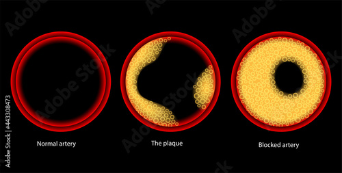 Cholesterol and atherosclerosis