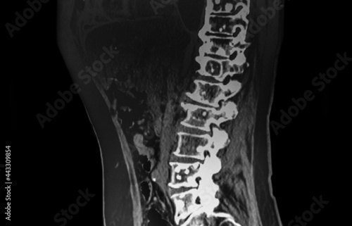 Spine CT Scan showing metastatic tumoral lesions