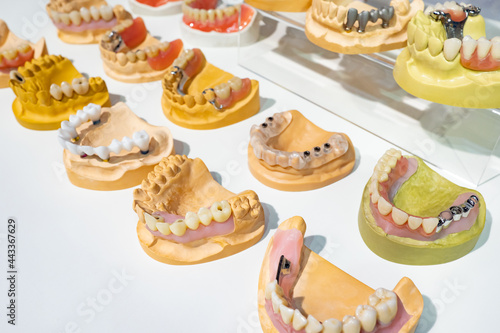 Various models prosthesis. Demonstration dentures jaws. Jaws with various diseases. Dental treatment. Demonstration models for dentist. Workplace dental technician. Production of dental prosthesis photo
