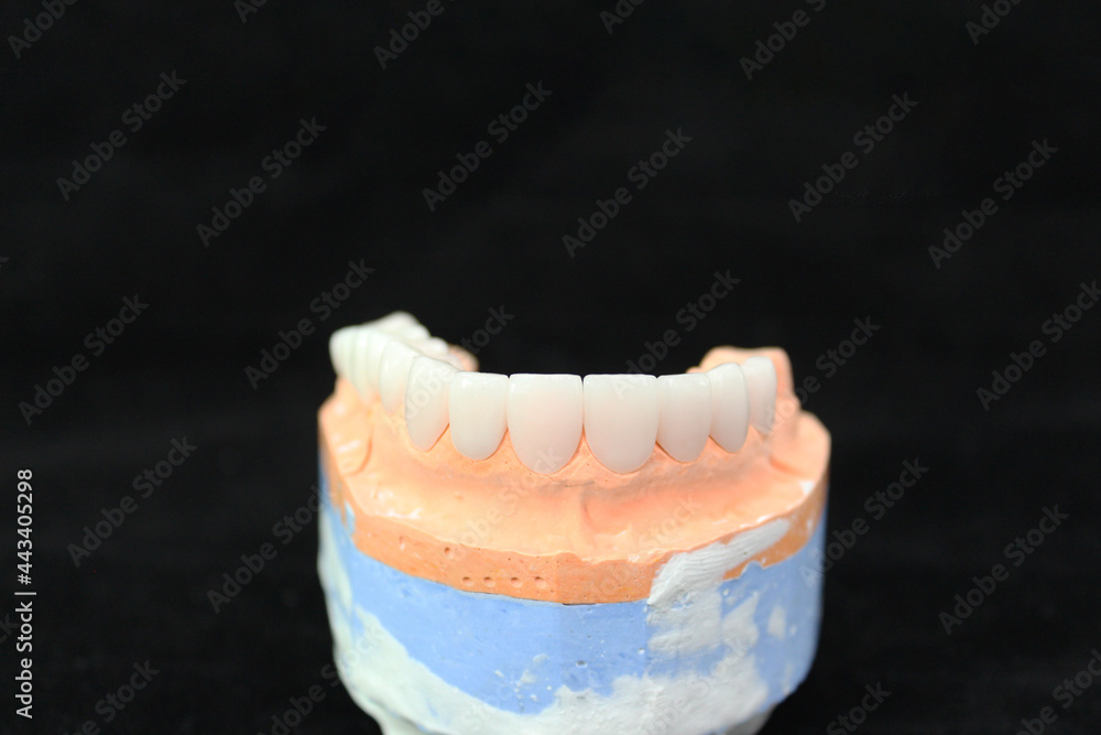 Dental crowns and veneers in the plaster model