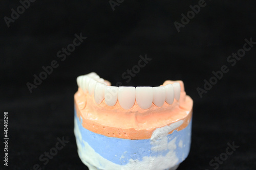 Dental crowns and veneers in the plaster model