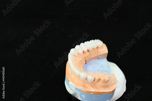 Dental crowns and veneers in the plaster model