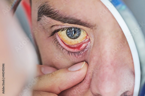 Human eye with yellow eyeball, closeup. Yellow eyes is a symptom of liver disease or hepatitis