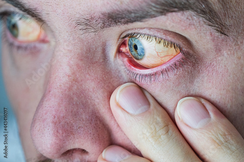 Human eye with yellow eyeball, closeup. Yellow eyes is a symptom of liver disease or hepatitis