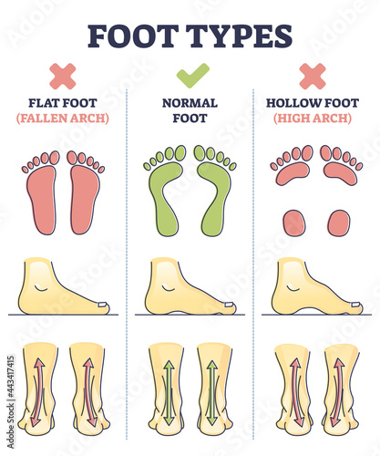 Foot types with flat, normal and hollow feet comparison in outline diagram. Educational medical explanation side view with orthopedic leg and medical deformation vector illustration. Footprint shapes.