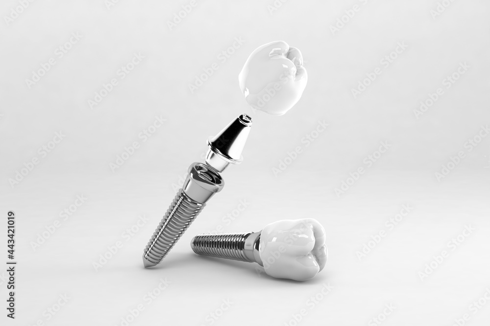 Detail of a false tooth implant fixed - obrazy, fototapety, plakaty 
