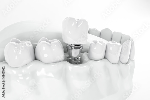 Detail of a false tooth implant fixed in the jaw
