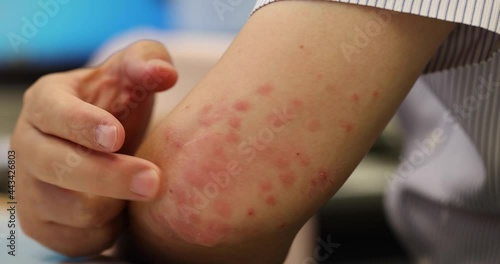 mosquito bits skin of man's elbow, creating a large area of bump, itching, swelling, soreness, and redness. hand cannot help scratching