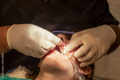 Bonding of dental braces and expander. Orthodontic treatment. Dentist put on archwire on metal brackets. Girl with open mouth at the dental chair. photo