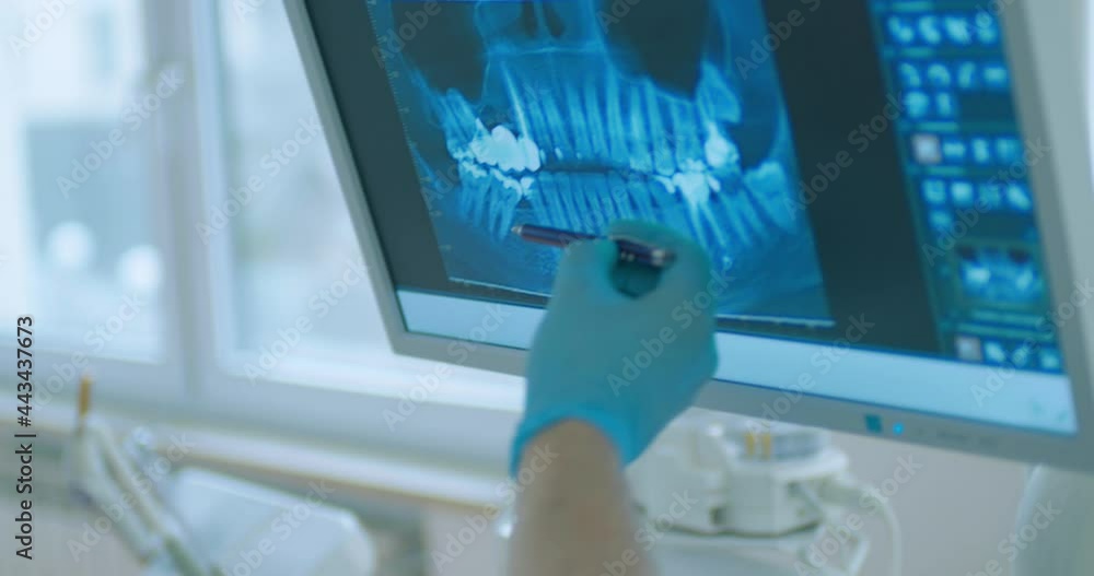 Close-up monitor screen with a picture of teeth computed tomography scan and male dentist is using a pen for showing teeth to an African American male patient in disposable eyeglasses. Close-up monitor screen with a picture of teeth computed tomography scan and male dentist is using a pen for showing teeth to an African American male patient in disposable eyeglasses.