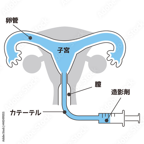 線画 子宮卵管造影検査 photo