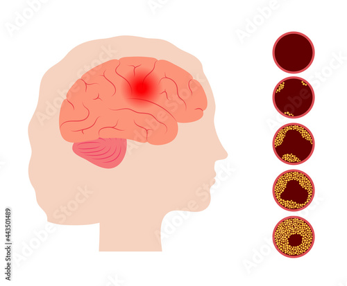 Brain stroke ishemic