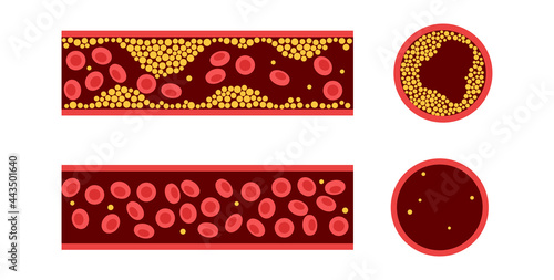 Cholesterol and atherosclerosis