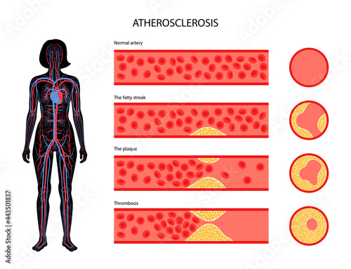 Cholesterol and atherosclerosis
