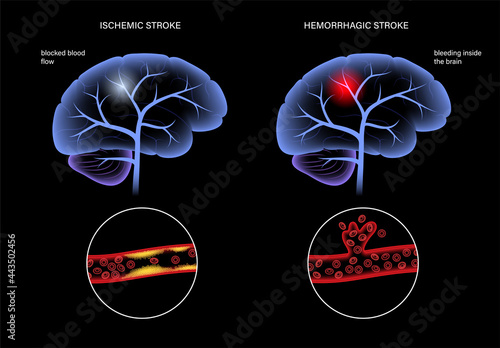 Brain stroke ishemic and hemorrhagic