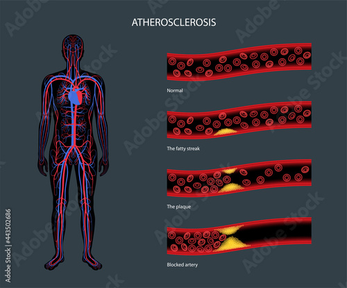 Cholesterol and atherosclerosis