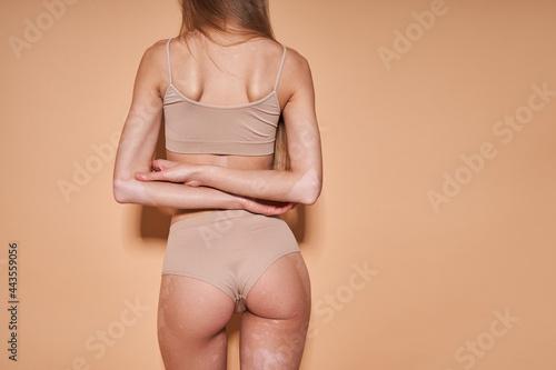 Girl with vitiligo skin and beautiful figure standing at the studio in front of the beige wall