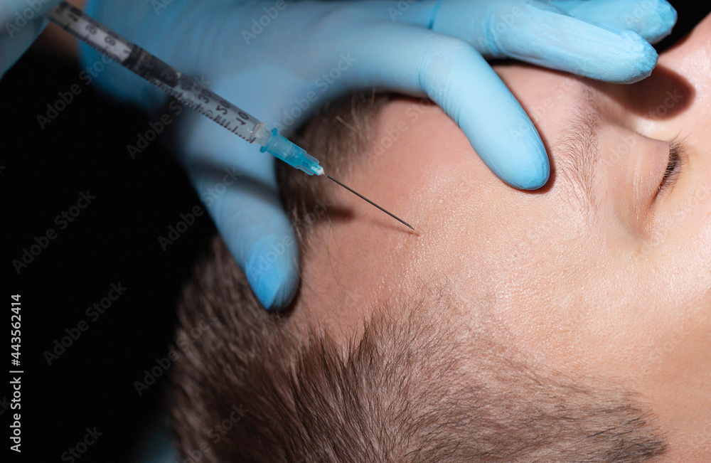 The doctor makes an injection of homeopathic mesotherapy hair of the skin on the man's head. Baldness treatment concept. Close-up The doctor makes an injection of homeopathic mesotherapy hair of the skin on the man's head. Baldness treatment concept. Close-up