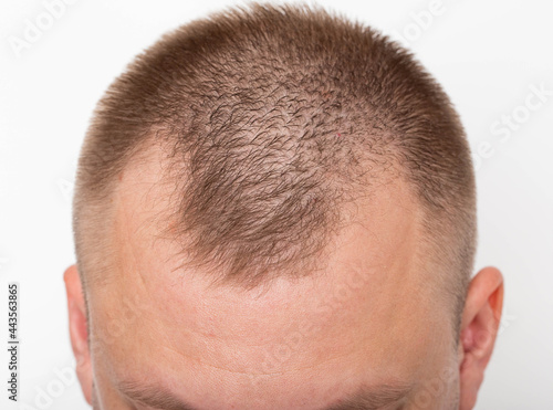 Bald patches on the head of a young man. The concept of the increased hormone dihydrotestosterone. Weakening of hair follicles