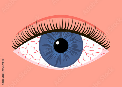 Inflamed sick eye with allergy symptom red veins. Eye fatigue or allergic conjunctivitis infection. Vector illustration