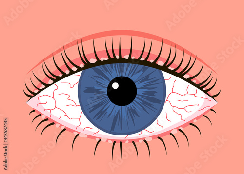Inflamed sick human eye with blepharitis, allergy symptom red veins. Eye disease, fatigue or allergic conjunctivitis infection. Vector illustration