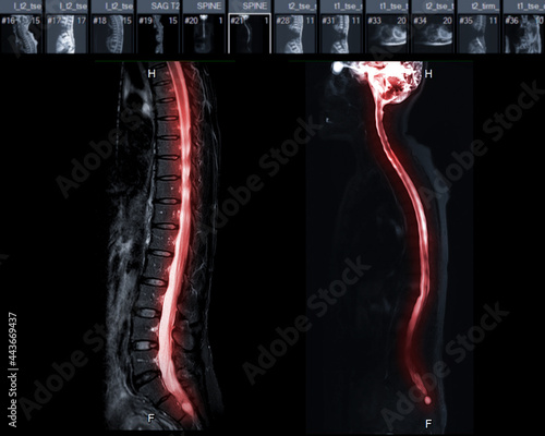 MRI of whole spine T2W sagittal plane for diagnostic Spinal Cord Compression.