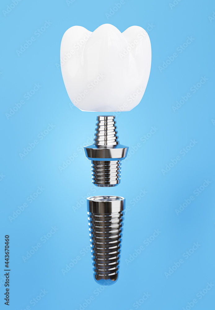 dental implant assembly on blue background dental implant assembly on blue background