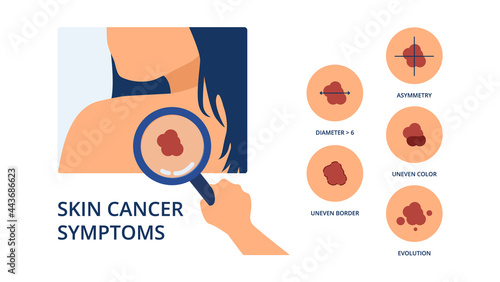 Skin cancer symptoms like big diameter, asymmetry, uneven color, uneven border and evolution next to hand of doctor detecting melanoma spot on skin of woman