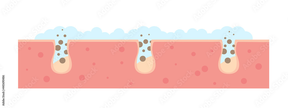 Cleaning blackheads process flat illustration. Clogged pores removal, skin cleaning foam, skincare. Can be used for topics like cosmetology, cosmetics. Shrinking and minimaizing face pores concept Cleaning blackheads process flat illustration. Clogged pores removal, skin cleaning foam, skincare. Can be used for topics like cosmetology, cosmetics. Shrinking and minimaizing face pores concept