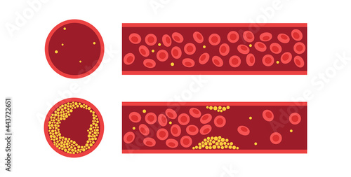 Cholesterol and atherosclerosis