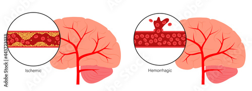 Canvas Print Brain stroke ishemic and hemorrhagic