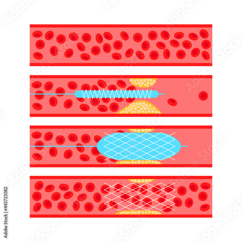 Angioplasty cardiac stent