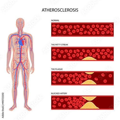 Cholesterol and atherosclerosis